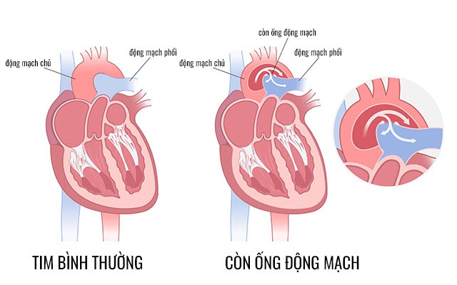 Câu hỏi thường gặp về còn ống động mạch