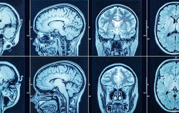 Thoát vị não: Nguyên nhân, triệu chứng, chẩn đoán và điều trị- Ảnh 3.