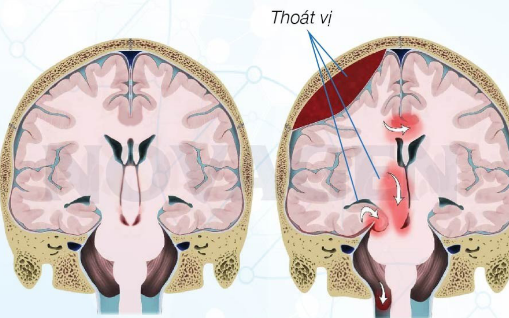 Thoát vị não: Nguyên nhân, triệu chứng, chẩn đoán và điều trị