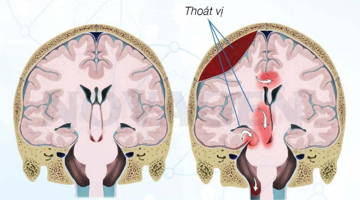 Thoát vị não: Nguyên nhân, triệu chứng, chẩn đoán và điều trị- Ảnh 2.