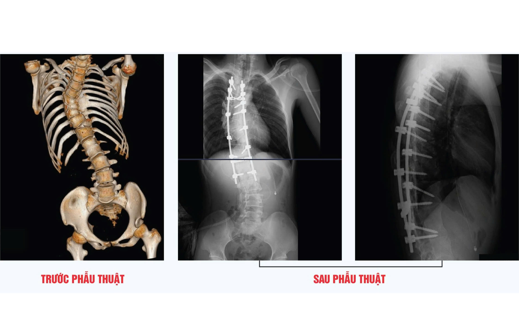 Phẫu thuật chỉnh cột sống hình chữ &quot;S&quot; thành công cho thanh niên 23 tuổi