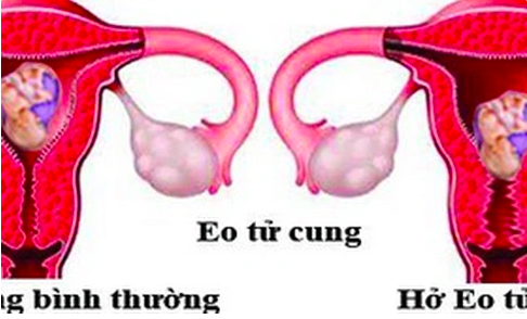 Hở eo tử cung: Nguyên nhân, biểu hiện, cách điều trị và phòng bệnh- Ảnh 1.