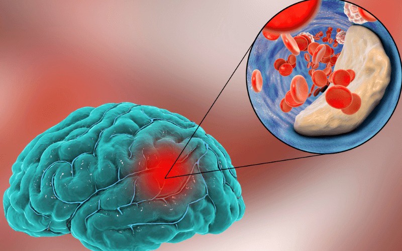 Nhồi máu não: Nguyên nhân, triệu chứng, cách điều trị và phòng ngừa