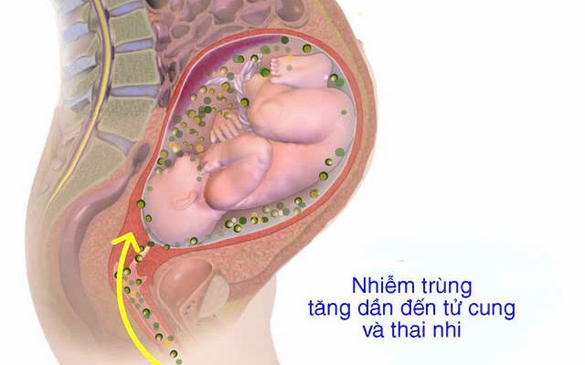 Bệnh viêm màng ối: Nguyên nhân, triệu chứng, phòng bệnh và cách điều trị