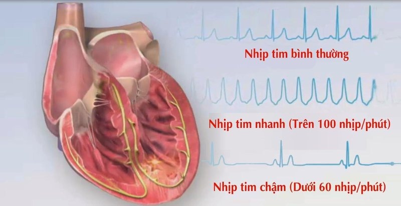 Nhịp tim chậm: Nguyên nhân, triệu chứng, cách điều trị và phòng ngừa- Ảnh 1.