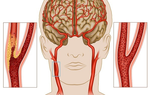 Nhồi máu não: Nguyên nhân, triệu chứng, cách điều trị và phòng ngừa- Ảnh 2.