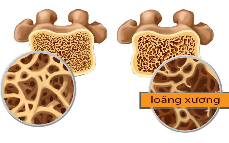 Loãng xương, ai cần đo mật độ xương?