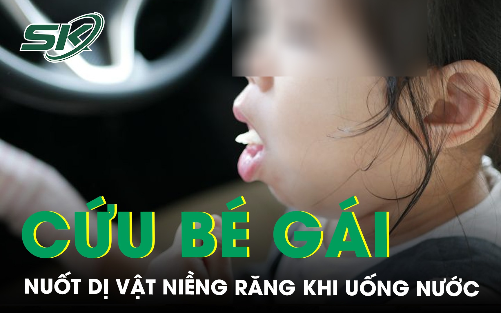 Bé gái cấp cứu do vô tình nuốt dị vật niềng răng khi uống nước