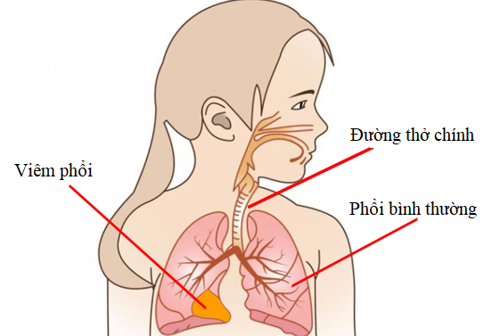 Những câu hỏi liên quan đến bệnh viêm phổi ở trẻ em- Ảnh 2.