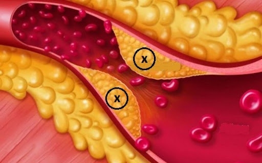 Rối loạn lipid máu nguy hiểm như thế nào?