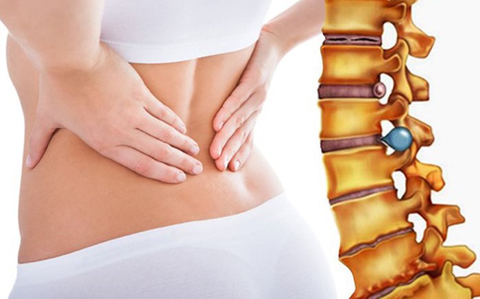 Khi nào cần phẫu thuật thoát vị đĩa đệm?