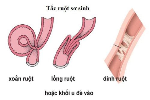 Câu hỏi thường gặp liên quan đến bệnh tắc ruột sơ sinh- Ảnh 1.