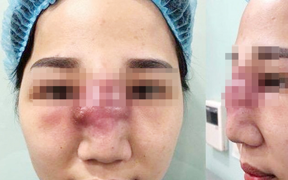 Bụng cô gái 25 tuổi 'biến dạng' sau mũi tiêm trị sẹo do hút mỡ- Ảnh 3.