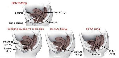 Sa sinh dục: Nguyên nhân, triệu chứng, cách phòng bệnh và điều trị- Ảnh 1.