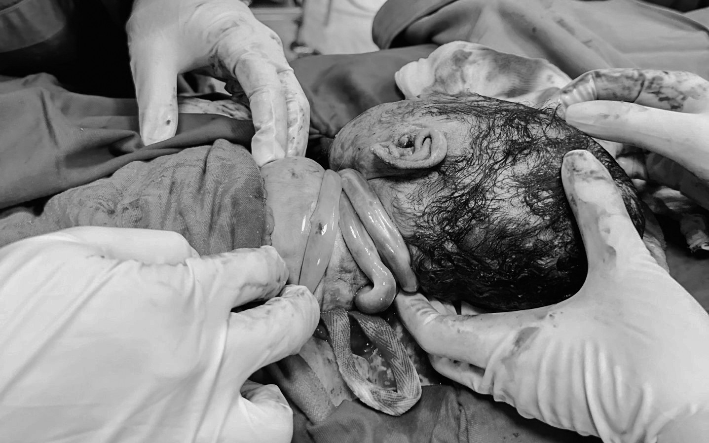 Mổ cấp cứu kịp thời, cứu an toàn thai nhi 40 tuần có dấu hiệu suy thai- Ảnh 2. Cứu sống bé sơ sinh dây rốn quấn 3 vòng quanh cổ, suy thai cấp