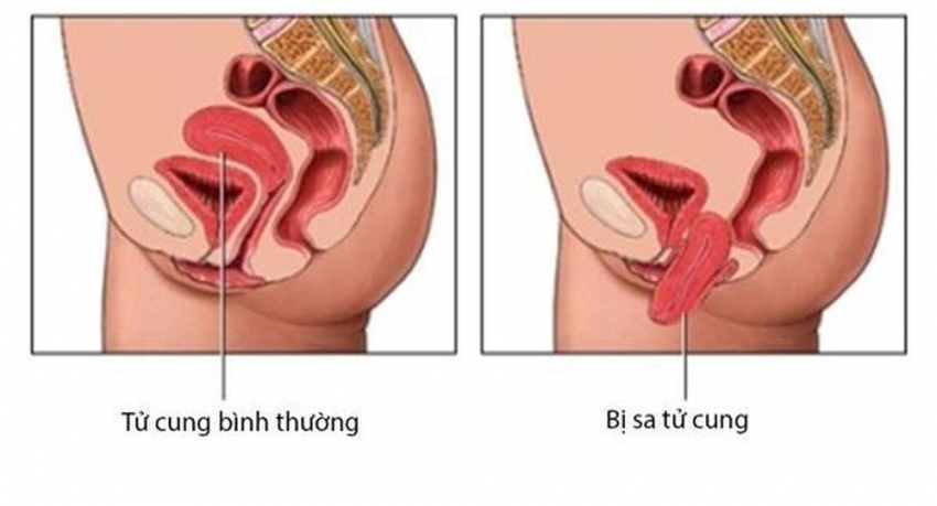 Sa sinh dục có biểu hiện như thế nào?- Ảnh 1.