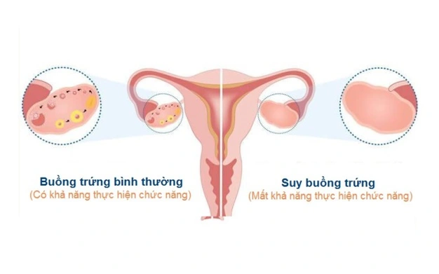 Suy buồng trứng: Nguyên nhân, triệu chứng, cách phòng ngừa