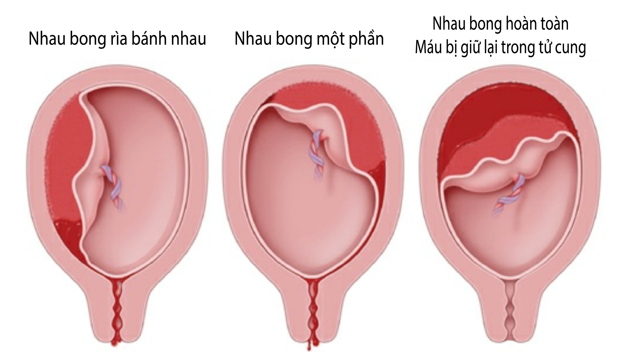 Nhau bong non: Nguyên nhân, triệu chứng, cách điều trị và phòng ngừa- Ảnh 2.