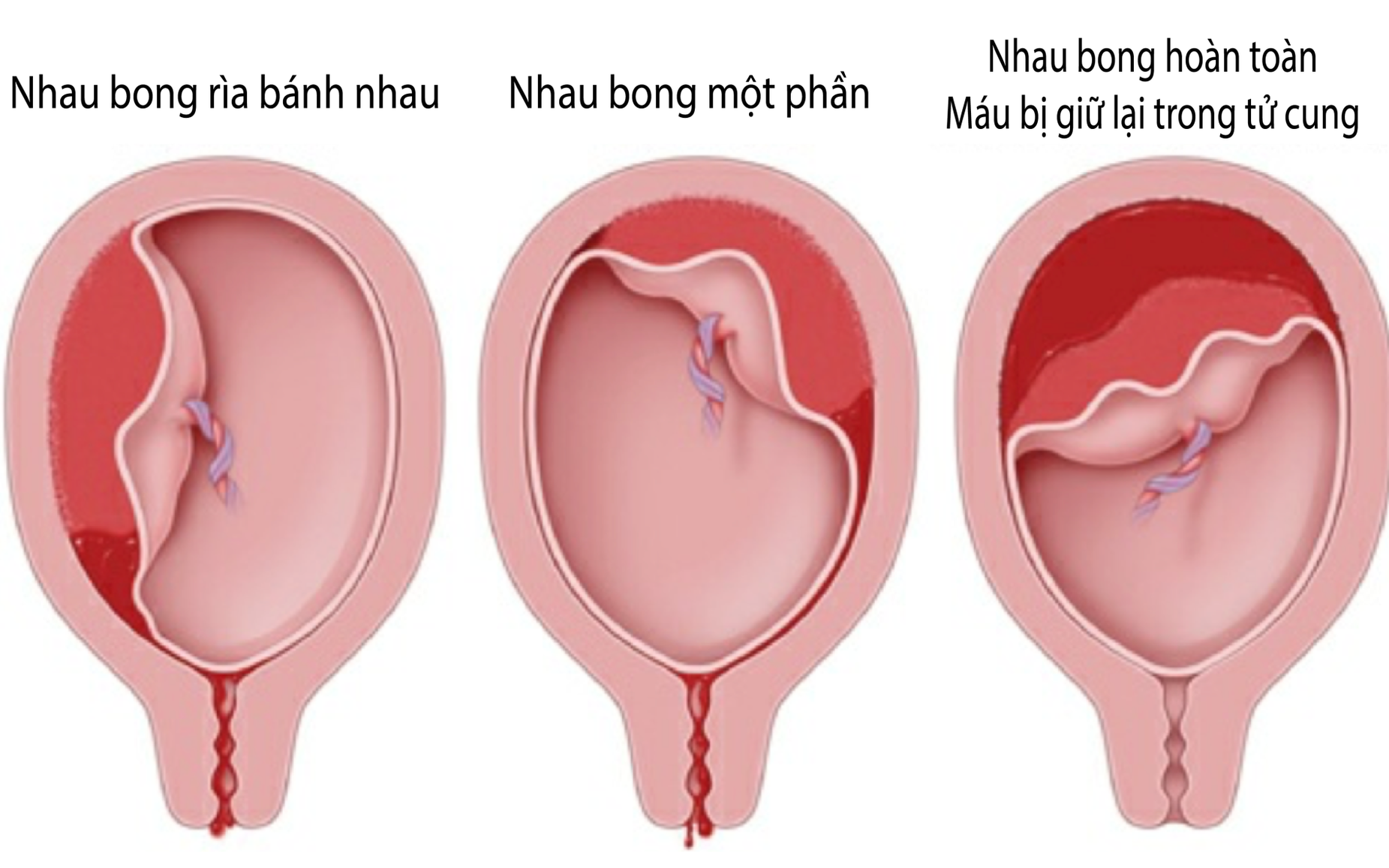 Nhau bong non: Nguyên nhân, triệu chứng, cách điều trị và phòng ngừa