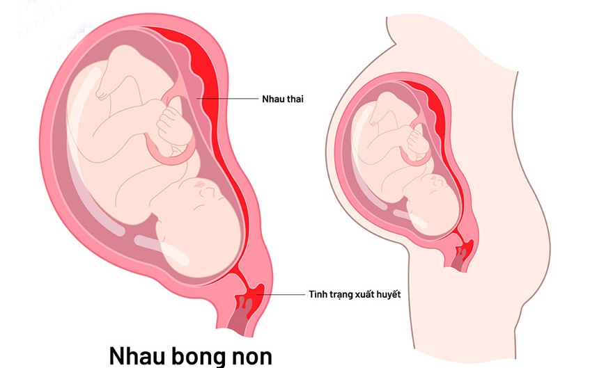 Các câu hỏi thường gặp liên quan đến nhau bong non