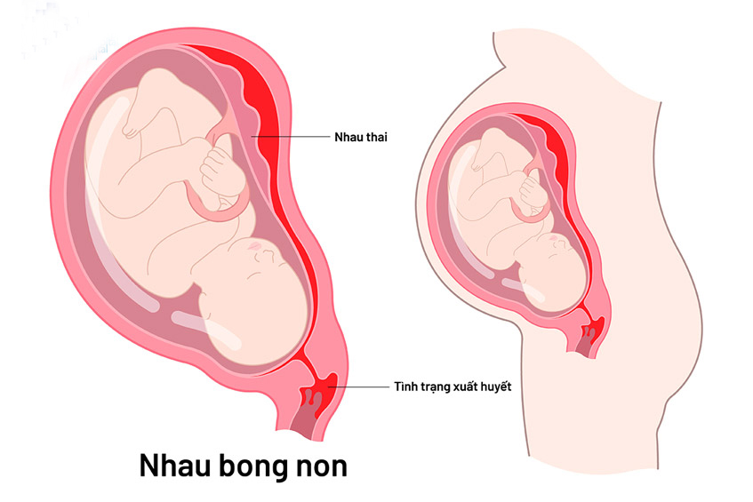 Các biện pháp xử trí, điều trị cho thai phụ bị nhau bong non- Ảnh 2.