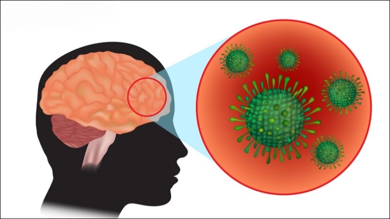 Phân biệt bệnh Parkinson và hội chứng Parkinson- Ảnh 2.