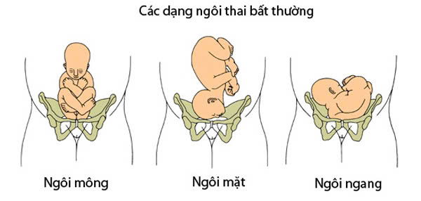 Vỡ ối non: Nguyên nhân, triệu chứng, cách điều trị và phòng bệnh- Ảnh 2.