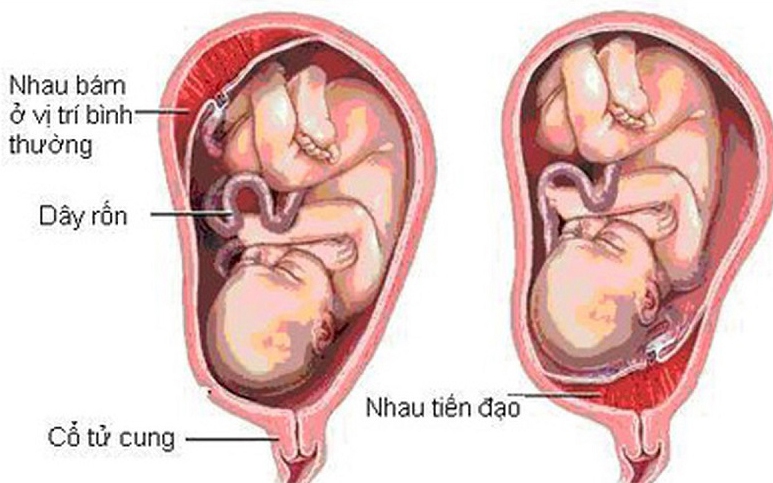 Nhau tiền đạo: Nguyên nhân, triệu chứng, cách điều trị và phòng ngừa