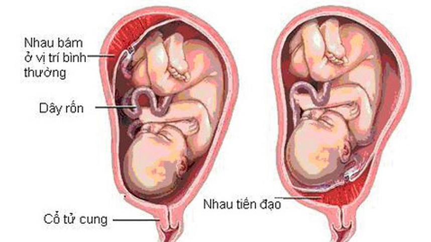 Nhau tiền đạo: Nguyên nhân, triệu chứng, cách điều trị và phòng ngừa- Ảnh 1.