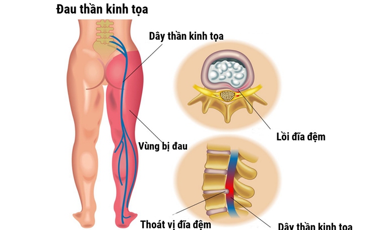 4 bài tập kéo giãn giảm đau thần kinh tọa