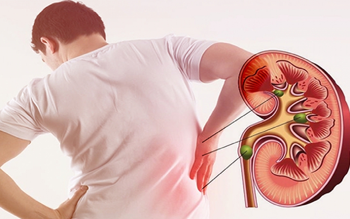 6 nguyên nhân gây sỏi thận nhiều người mắc phải