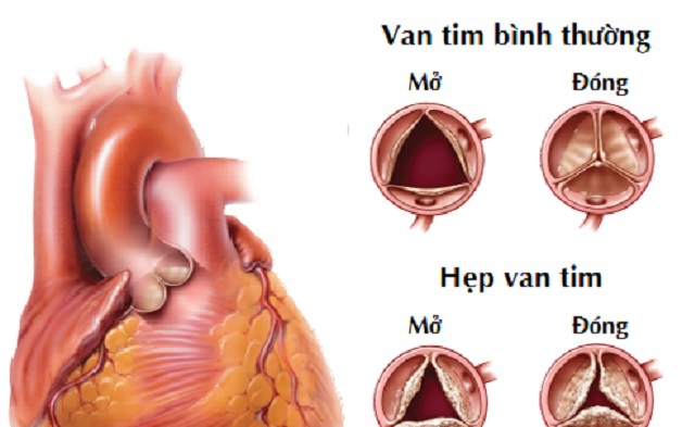 Dấu hiệu sớm bệnh tim bẩm sinh ở trẻ