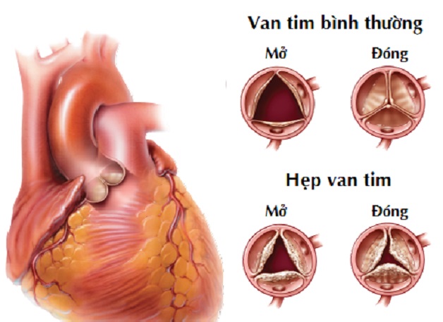 Dấu hiệu sớm bệnh tim bẩm sinh ở trẻ