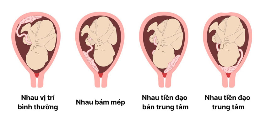 Phương pháp điều trị cho thai phụ bị nhau tiền đạo- Ảnh 1.