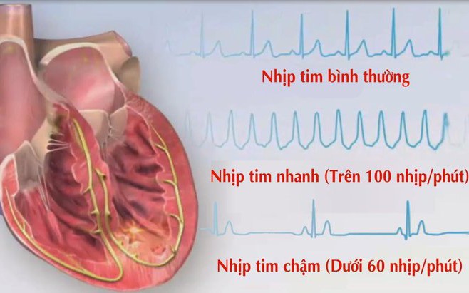 Nhịp tim chậm có nguy hiểm không?