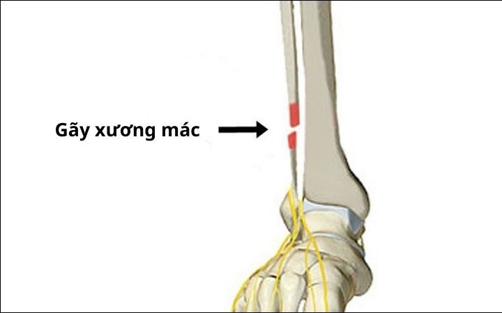 Gãy xương mác nên tập luyện như thế nào?