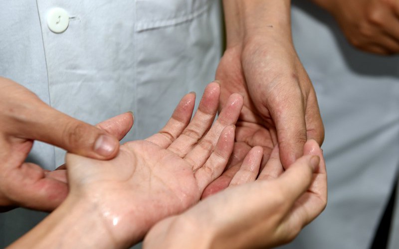 Ra mồ hôi tay nhiều phải làm sao?