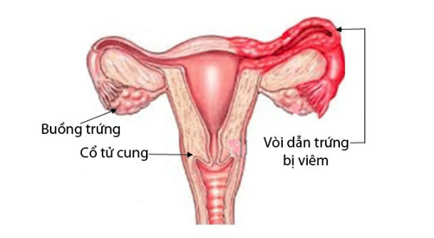 Viêm ống dẫn trứng: Nguyên nhân, triệu chứng, phòng bệnh và cách điều trị- Ảnh 1.