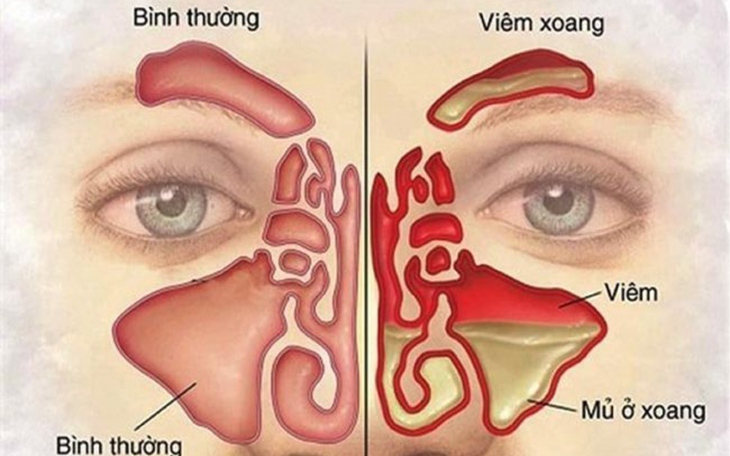 Những người dễ mắc bệnh viêm xoang