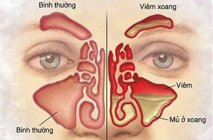 Những người dễ mắc bệnh viêm xoang- Ảnh 1.