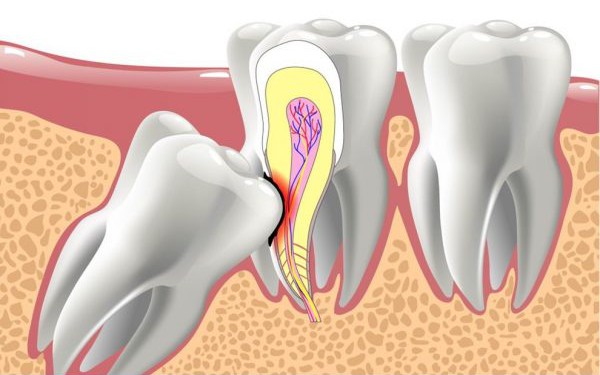 Răng mọc lạc chỗ có dấu hiệu gì?