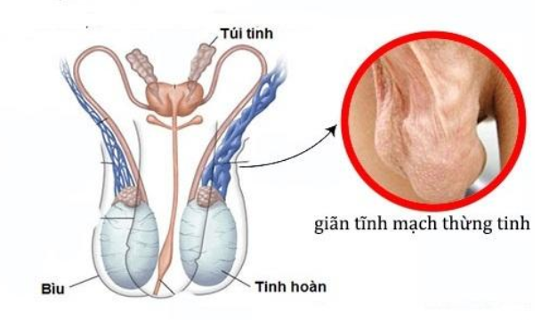 Bị giãn tĩnh mạch thừng tinh cần chú ý gì về thực phẩm?- Ảnh 1.