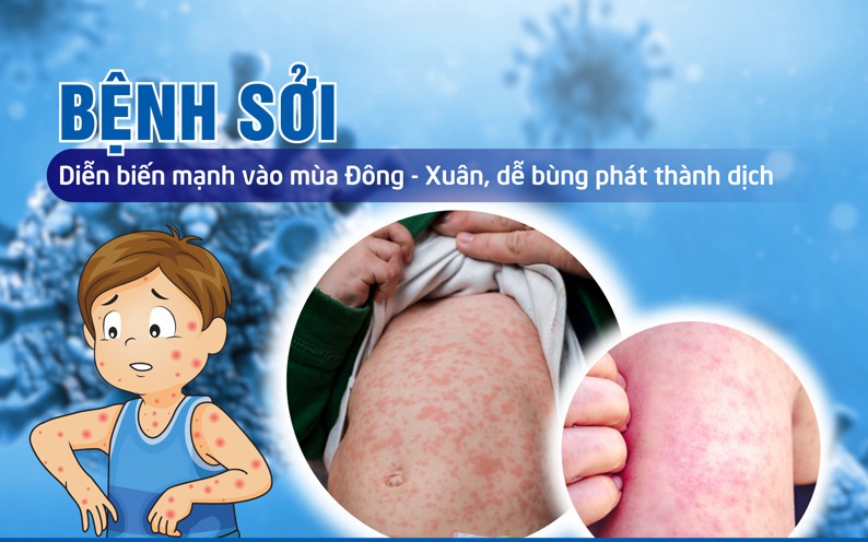 Thủ tướng yêu cầu tăng cường các biện pháp phòng, chống bệnh sởi