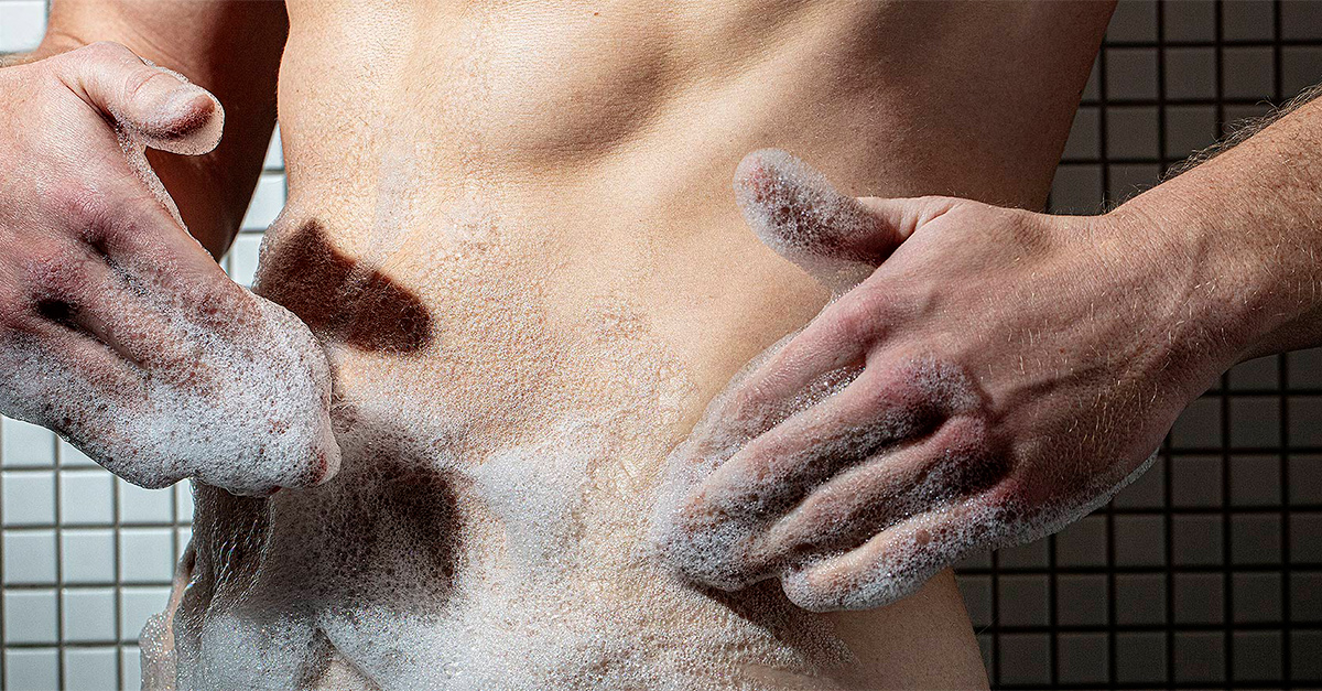 Hiếm gặp, áp xe tinh hoàn do bệnh Whitmore: Cảnh báo nguy cơ phải cắt bỏ tinh hoàn- Ảnh 1.