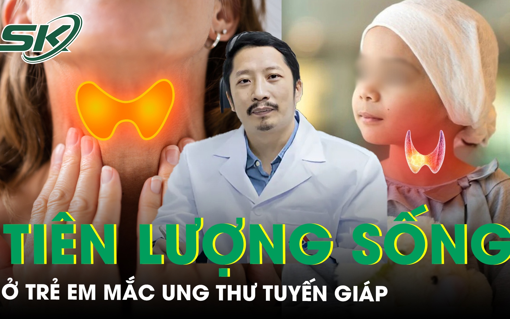 Ung thư tuyến giáp ở trẻ em có đặc điểm gì khác so với người lớn, tiên lượng sống như thế nào?