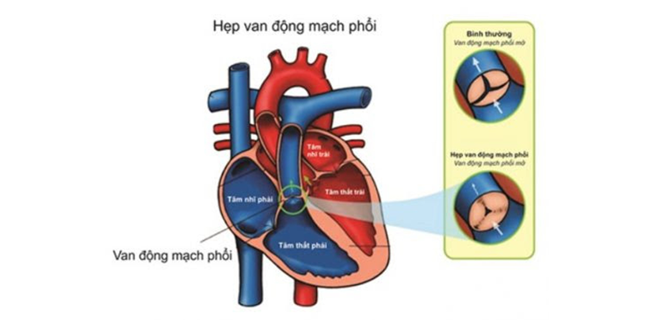 Thuốc nào điều trị hẹp van động mạch phổi?- Ảnh 1.