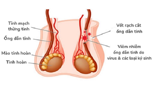 Viêm ống dẫn tinh điều trị như thế nào ?- Ảnh 2.