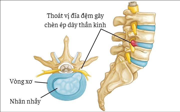 Đau lưng dưới do ngồi nhiều làm sao phòng tránh?