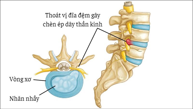 Đau lưng dưới do ngồi nhiều làm sao phòng tránh?- Ảnh 1.