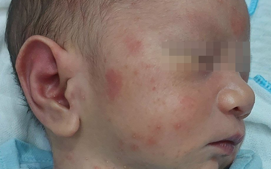 Da khô ngứa khi thời tiết lạnh, cẩn thận với viêm da cơ địa